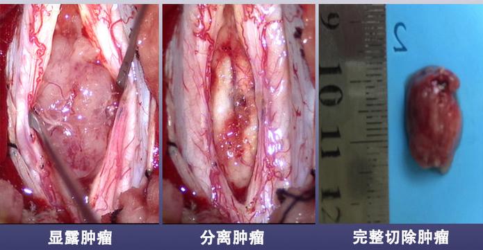 马尾seo团队_特殊病例  椎管内穿刺置管后出现马尾神经综合征最终查出了室管膜瘤 马尾seo团队_特殊病例  椎管内穿刺置管后出现马尾神经综合征最终查出了室管膜瘤 神马SEO