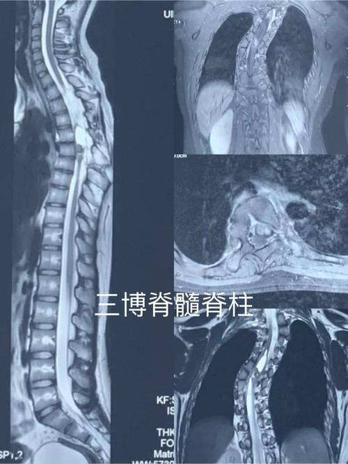马尾区有用的seo哪家好_椎管内畸胎瘤合并脊柱侧弯治疗 神马SEO 马尾区有用的seo哪家好_椎管内畸胎瘤合并脊柱侧弯治疗 马尾区有用的seo哪家好_椎管内畸胎瘤合并脊柱侧弯治疗 神马SEO