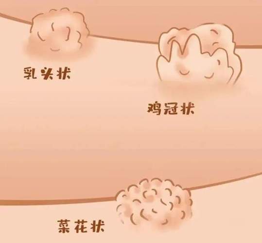 菜花状阴囊肉粒,介绍其成因、症状与防治方法 百度SEO 菜花状阴囊肉粒,介绍其成因、症状与防治方法 菜花状阴囊肉粒,介绍其成因、症状与防治方法 百度SEO
