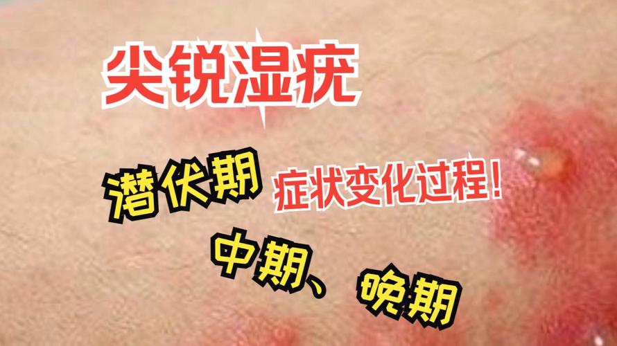 尖湿锐早期图片,介绍疾病的前哨战 SEO关键词 尖湿锐早期图片,介绍疾病的前哨战 尖湿锐早期图片,介绍疾病的前哨战 SEO关键词